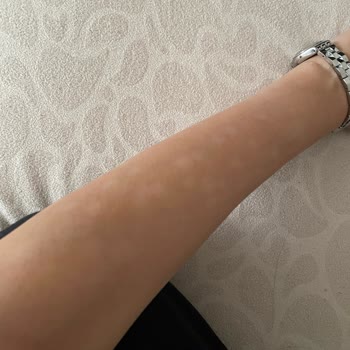 Özel Çapa Hastanesi Epilasyonda Yaktılar Vücudumu