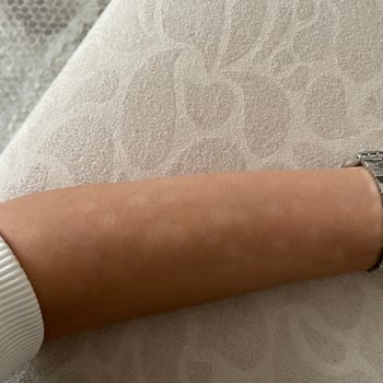 Özel Çapa Hastanesi Epilasyonda Yaktılar Vücudumu