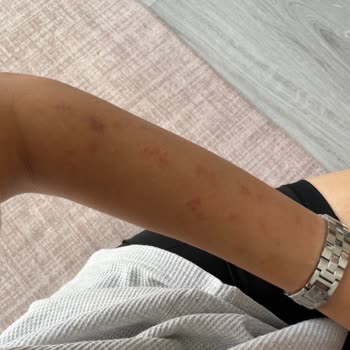 Özel Çapa Hastanesi Epilasyonda Yaktılar Vücudumu