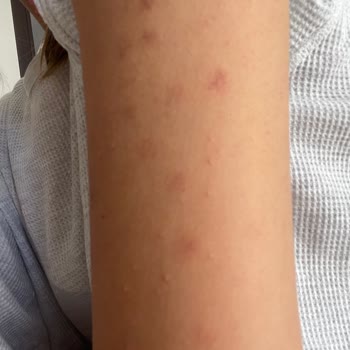 Özel Çapa Hastanesi Epilasyonda Yaktılar Vücudumu