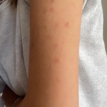 Özel Çapa Hastanesi Epilasyonda Yaktılar Vücudumu