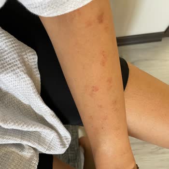 Özel Çapa Hastanesi Epilasyonda Yaktılar Vücudumu