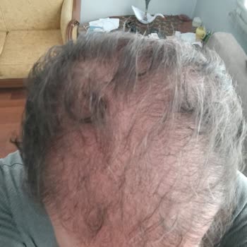 Marden Clinic Saç Ekim Pişmanlığı