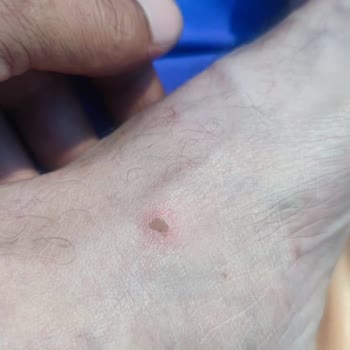 SuperStep Lacoste Terliklerin Yara Yapması