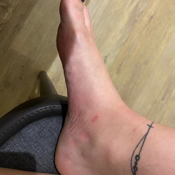 SuperStep Lacoste Terliklerin Yara Yapması