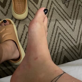 SuperStep Lacoste Terliklerin Yara Yapması