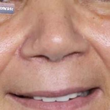 Esteworld/Wellworld Ataşehir'de Rinoplasti Şikayeti