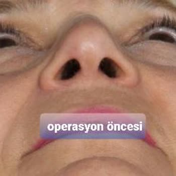 Esteworld/Wellworld Ataşehir'de Rinoplasti Şikayeti