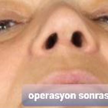 Esteworld/Wellworld Ataşehir'de Rinoplasti Şikayeti