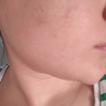 Rise & Shine Dilan Polat Ürünü: Yüzümde Tahrişe Neden Oldu