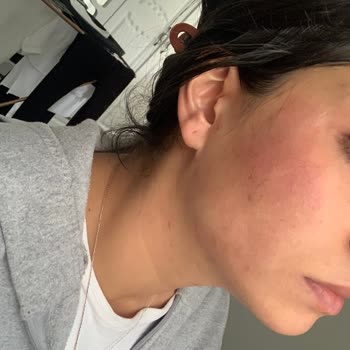 Vi-Vet Tüy Sarartıcı Yüzüme Sürdükten 1 Dakika Sonra Yanma Hissi Oluştu