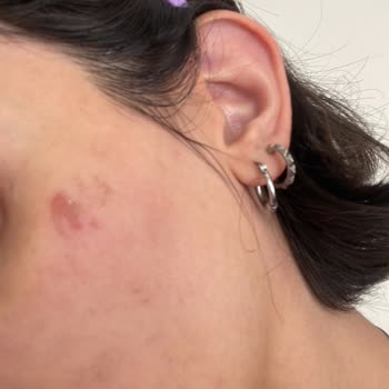 Vi-Vet Tüy Sarartıcı Yüzüme Sürdükten 1 Dakika Sonra Yanma Hissi Oluştu