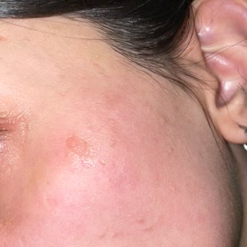 Vi-Vet Tüy Sarartıcı Yüzüme Sürdükten 1 Dakika Sonra Yanma Hissi Oluştu