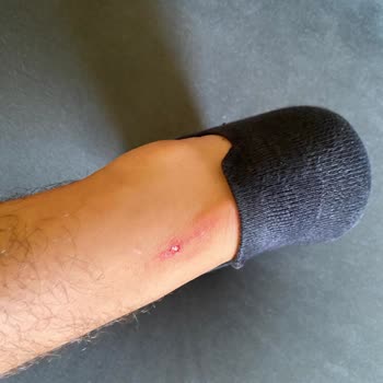 Adidas Ayak Arkasının Vurması