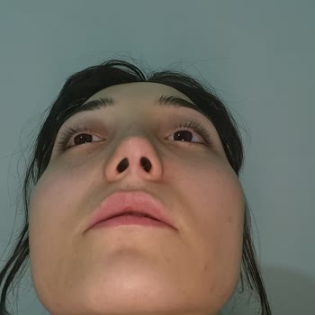 Vanity Estetik Burnum Yamuk Yapıldı Ve Revizyon Yapmıyorlar