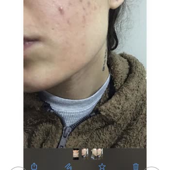 Estetisyen Fatoş Çeçen Yüzümü Mahvetti Para İademin Tamamını İstiyorum