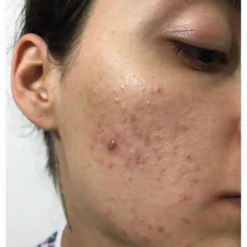 Estetisyen Fatoş Çeçen Yüzümü Mahvetti Para İademin Tamamını İstiyorum