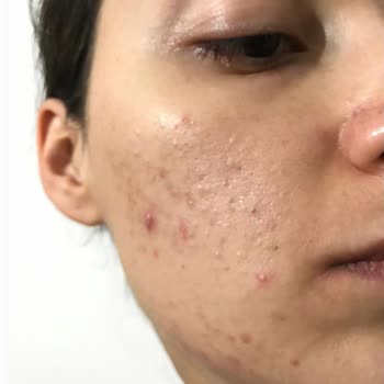 Estetisyen Fatoş Çeçen Yüzümü Mahvetti Para İademin Tamamını İstiyorum