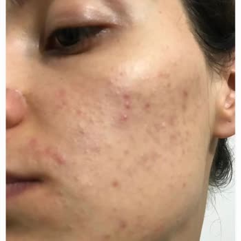 Estetisyen Fatoş Çeçen Yüzümü Mahvetti Para İademin Tamamını İstiyorum