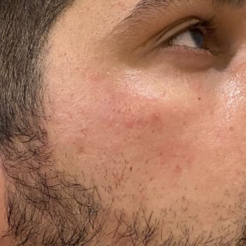 Claderm Marka Kalitesiz Kil Maskesi!