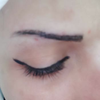 Renew Beauty Lazer Epilasyon Yüz Bölgesi