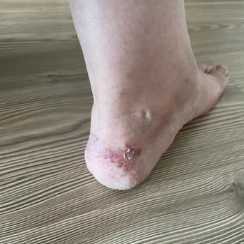 Skechers Shoes Left My Feet in Terrible Shape