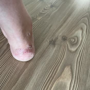 Skechers Shoes Left My Feet in Terrible Shape