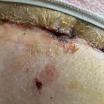 Dr. Bilgehan Aydın Karın Germe Ameliyatı Pişmanlığı