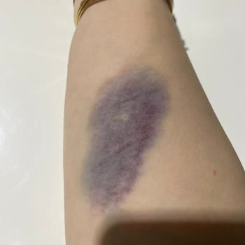 Özel Çağsu Hastanesi Serum Takıldı Damarım Çatladı