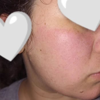 Bee Beauty Kağıt Maske Yüzüme Zarar Verdi