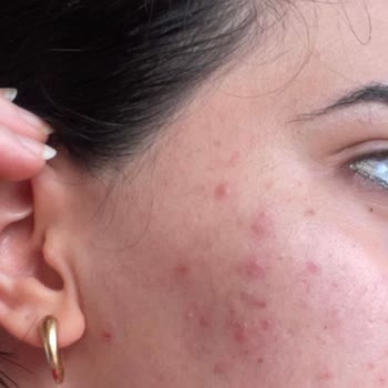 Avene Intense Protect Güneş Kremi Sivilceler Çıkarttı.