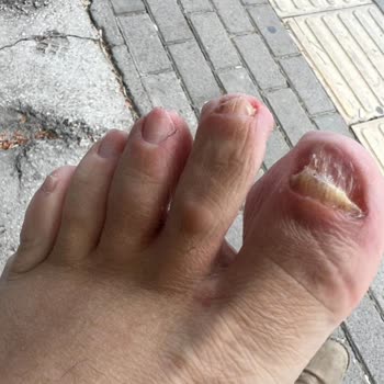 Fsm Ayak Bakım Merkezi Enfeksiyon Riski Oluştu