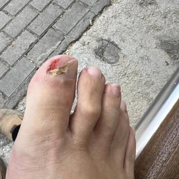 Fsm Ayak Bakım Merkezi Enfeksiyon Riski Oluştu