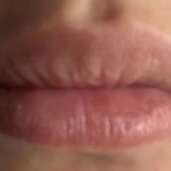 Time Esthetic Dudak Dolgum Tutmadı