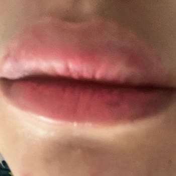 Time Esthetic Dudak Dolgum Tutmadı