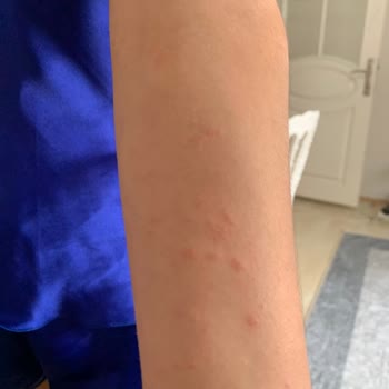 Bee Beauty Sabun 🧼 Alerji Yaptı!