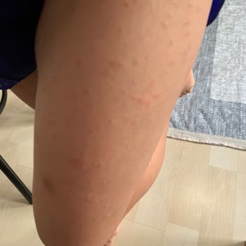 Bee Beauty&nbsp; Sabun 🧼 Alerji Yaptı!