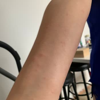 Bee Beauty Sabun Alerji Yaptı