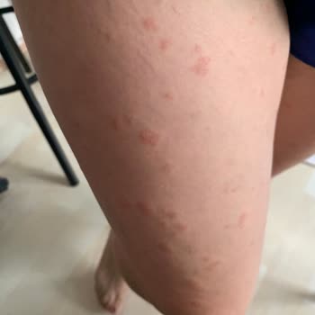 Bee Beauty Sabun Alerji Yaptı