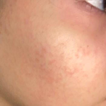 La Roche - Posay Effacler Temizleme Jeli Yüzümde Yan Etki Yarattı