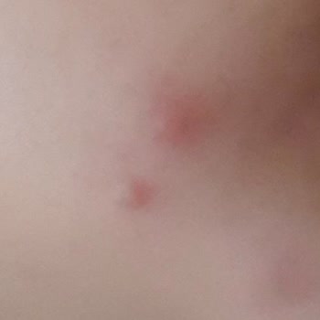 Evkur Alışveriş Gaziantep Mağazasından Aldığım Duaderm Kremler Yüzümü Berbat Hale Getirdi