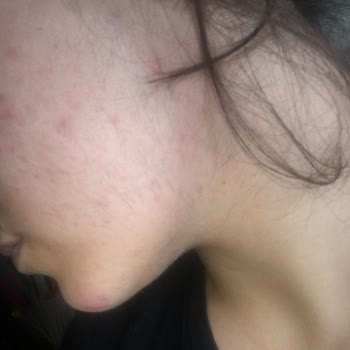 Blue White Estetik Ve Güzellik Salonu Yüzümü Mahvetti Ve Yalan Söyledi