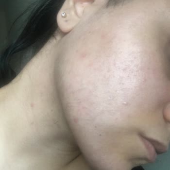 Blue White Estetik Ve Güzellik Salonu Yüzümü Mahvetti Ve Yalan Söyledi