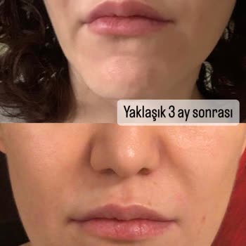 Medicall Clinic Güzellik Hizmetleri 10 Yaş Yaşlandırdı Yüzümü