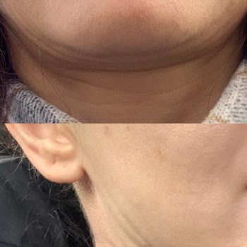 Medicall Clinic Güzellik Hizmetleri 10 Yaş Yaşlandırdı Yüzümü