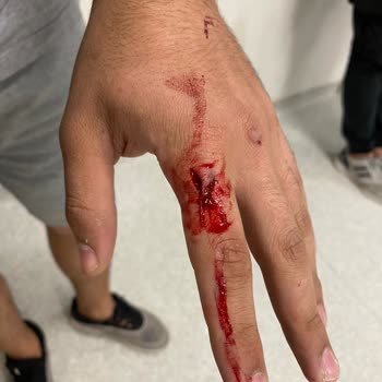 Durul Duşakabin Ürünün Parçalanarak Yaralamaya Sebep Vermesi