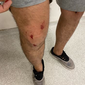 Durul Duşakabin Ürünün Parçalanarak Yaralamaya Sebep Vermesi