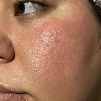 Mersin Marina Gratis Beauty Merkezi İşlem Sonrası Reaksiyonlar