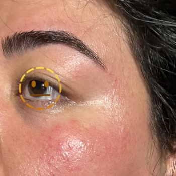Mersin Marina Gratis Beauty Merkezi İşlem Sonrası Reaksiyonlar