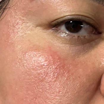 Mersin Marina Gratis Beauty Merkezi İşlem Sonrası Reaksiyonlar